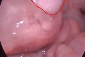 扁桃体肿物，严重吗，看看这些图就知道了图片