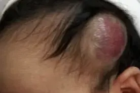 都说孩子有血管瘤一定小心别破溃，主要需要注意这些图片