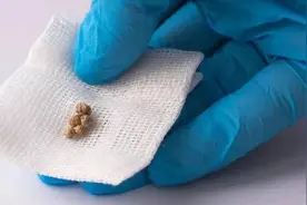 长期不吃早餐，真的会“饿”出胆结石？图片