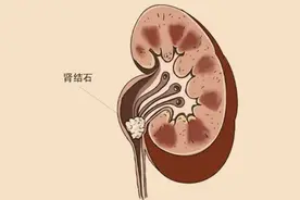 肾结石饮食大全图片