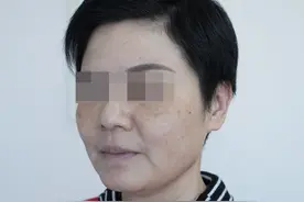 51岁大姐做了五层提升，晒一晒前后对比，术后堪比“换脸”！图片