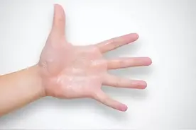 一到换季手就脱皮，到底咋回事？原因不只是缺维生素…图片