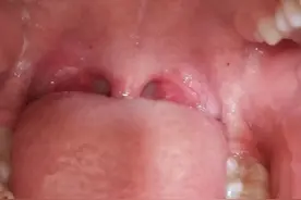 记录孩子得手足口病到痊愈的过程图片