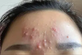 烂脸是如何治好的图片