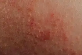 40岁女子胸部长了块湿疹，瘙痒难耐，医生大惊失色：这是癌症图片