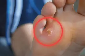 脚底好痛！骨科专家教你分辨长“疣”、“鸡眼”还是“跖痛”？图片