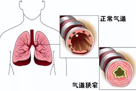 支气管炎用什么方法见效最快？这几点在夏天千万不能错过图片