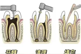 根管治疗需要去几次牙才能好？图片
