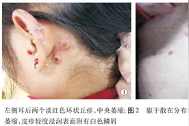 梅毒皮肤损害的样式不止一种，皮肤出现这些情况要警惕图片