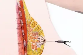 乳腺甲状腺外科特色技术丨乳管镜检查图片
