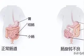 新生宝宝反复吐奶，排便带血，竟因肠子在“打转”！医生争分夺秒抢救......图片