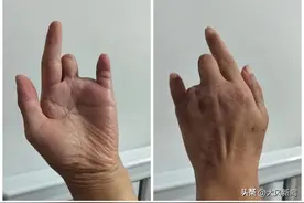 时间文号相同结论不一，伤残鉴定书咋出“双胞胎”？鉴定部门：录错了，标准适用错误所致图片