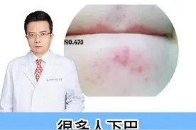 下巴长痘怎么办，教你一个简单的小方法 #科普#痘痘#痘印#甲硝唑凝胶 #壬二酸 视频封面