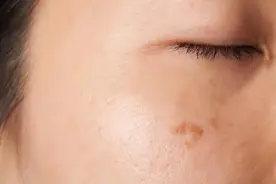 尿毒症是“拖”出来的？医生：皮肤4种症状，可能是肾脏在呼救图片