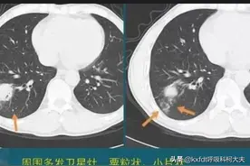 肺部占位性病变有哪些？图片
