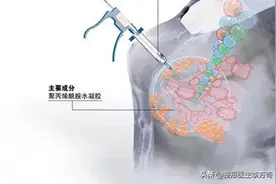 奥美定注射隆胸后果堪忧，该如何进行取出？图片