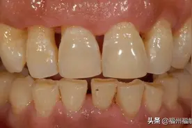 牙缝大是什么征兆？牙医：牙缝变大的主要原因、解决方法已整理好图片