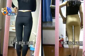 术后趴睡半个月，“抽的”和“填的”都不满意图片