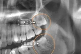 所有智齿都要拔吗？智齿不拔有哪些危害？图片