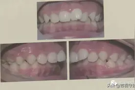 6岁娃口腔冒白点，竟是长了“双排牙”图片