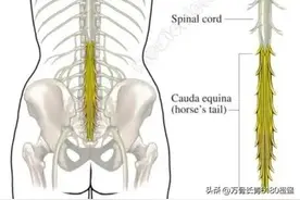 为什么有些腰椎间盘突出需要早做手术？图片