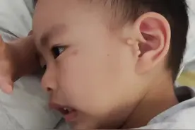 终于把附耳切除了图片