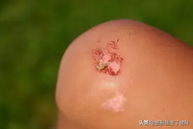 皮肤擦伤不用慌，这样处理瘢痕最小图片