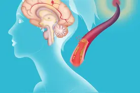 脑出血和脑梗死请注意，3个月内康复是关键，90%能恢复走路图片