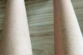 冬季高发鱼鳞病 做好护理是关键图片