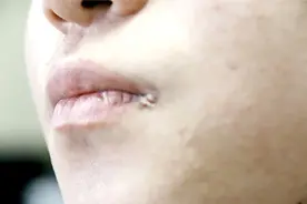 嘴唇总是起泡？可能不是上火，而是病毒感染，可能会终身携带图片