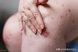 湿在皮、在肌、在血，在中焦，名医这些祛湿的方子要收好图片