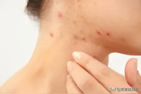 脸颊上硬硬的包，处理办法的“最优解”，记得收藏图片