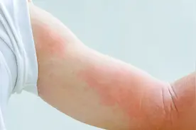 主兼结合——浅谈治疗划痕型荨麻疹的一点心得图片