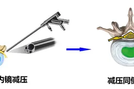 腰椎管狭窄症的微创治疗图片