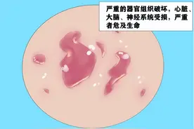 一经感染，终身标记，梅毒到底有多可怕？图片