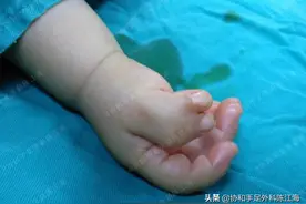 六指并不是简单“一刀切”，手指畸形儿，是上帝忘记亲吻的孩子图片