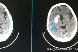 丁苯酞胶囊是治疗脑梗死、脑动脉硬化的常用药，能长期服用吗？图片