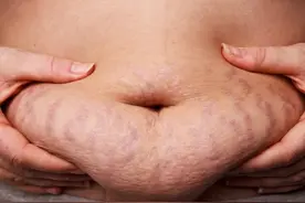 孕21周开始长妊娠纹！肚脐上方妊娠线长度能判断胎儿性别？图片