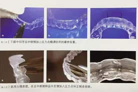 正畸医生须知：监控调整｜阶段调整之重启、精调、微调图片