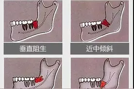 发生「阻生智齿」的6种表现，牙医建议：最好在这个年龄段拔除！图片