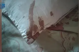 男子熟睡时疑被老鼠咬破头图片