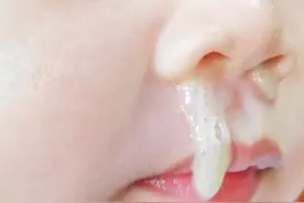 怎样分别过敏性鼻炎与其他疾病的症状图片