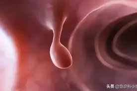 为什么肠道容易长“息肉”？肠内若有息肉，身体会有什么症状？图片