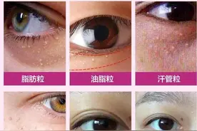眼睛周围长小疙瘩是什么？图片