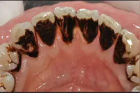 牙缝里面的烟渍茶渍真能刷掉？自用白牙妙招分享，满嘴牙渍全没了图片