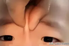 #健康中国行动2030# 【斗鸡眼？歪头看？到底什么是斜视？ 】图片