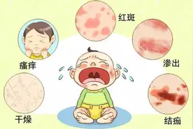 宝宝湿疹如何正确护理？母乳妈妈要忌口吗？听听小租怎么说图片