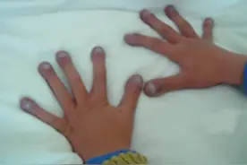 为什么我的指甲是蓝色的？图片