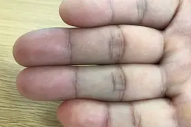 手指疼痛，不能弯曲，怎么回事？医生：都因干活太多，得了腱鞘炎图片