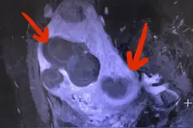 微波消融、射频、激光、海扶刀治疗子宫肌瘤的效果竟然差别这么大图片